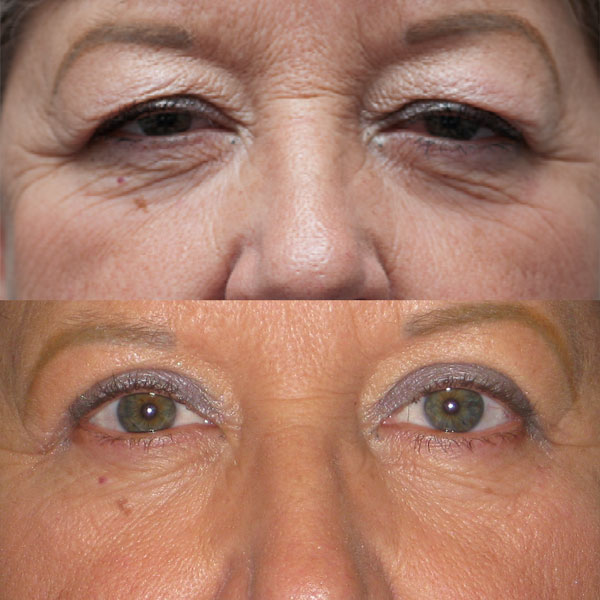 facial plastic surgery - eyelid lift