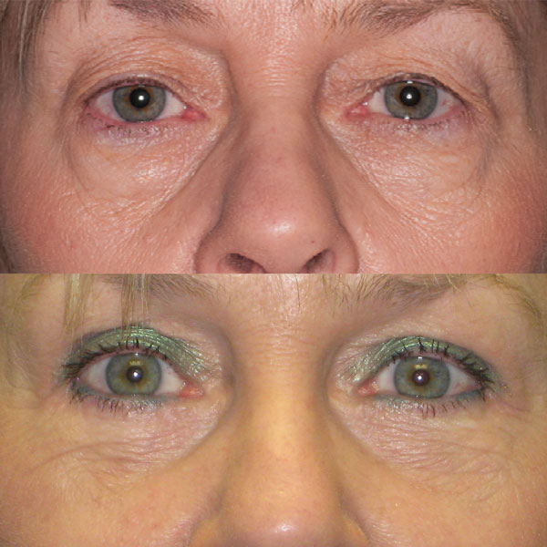 Upper and lower eyelid blepharoplasty
