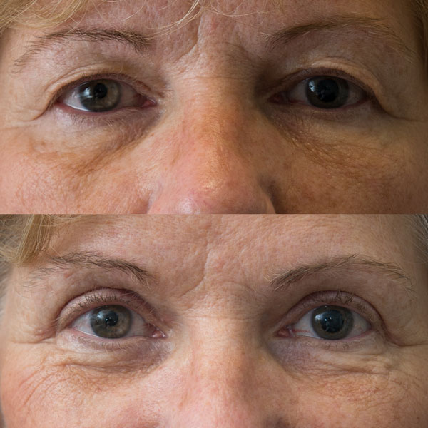 Upper eyelid blepharoplasty