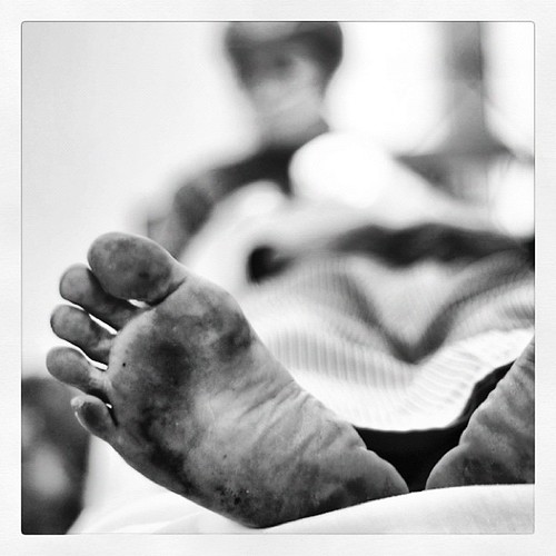 Dirty feet, happy patient