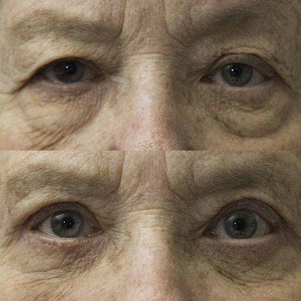 Upper and lower eyelid blepharoplasty