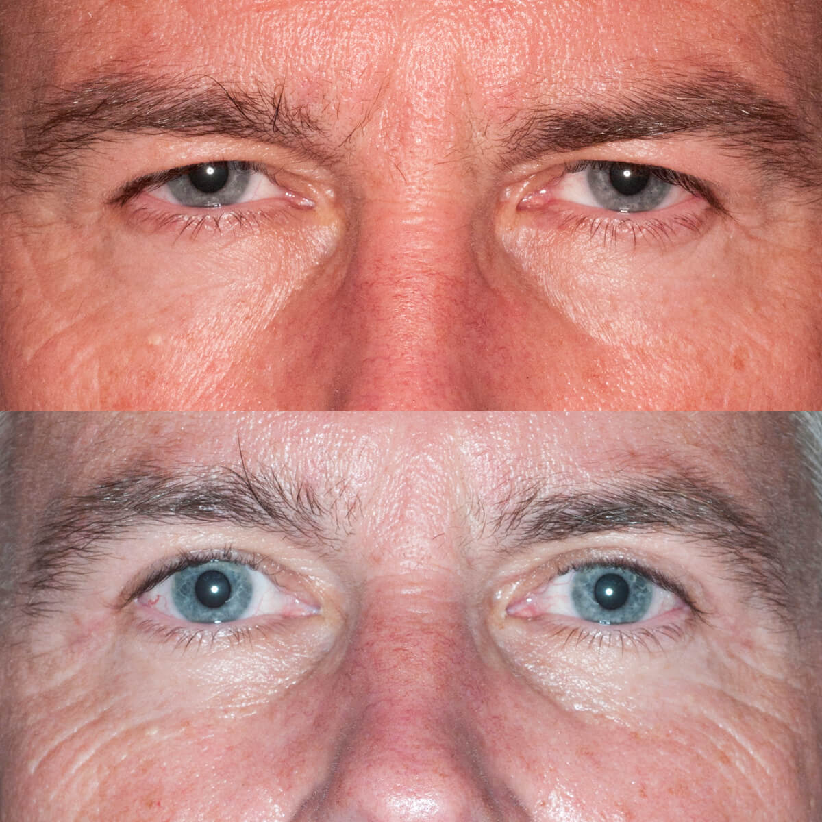 Upper eyelid blepharoplasty Upper eyelid blepharoplasty
