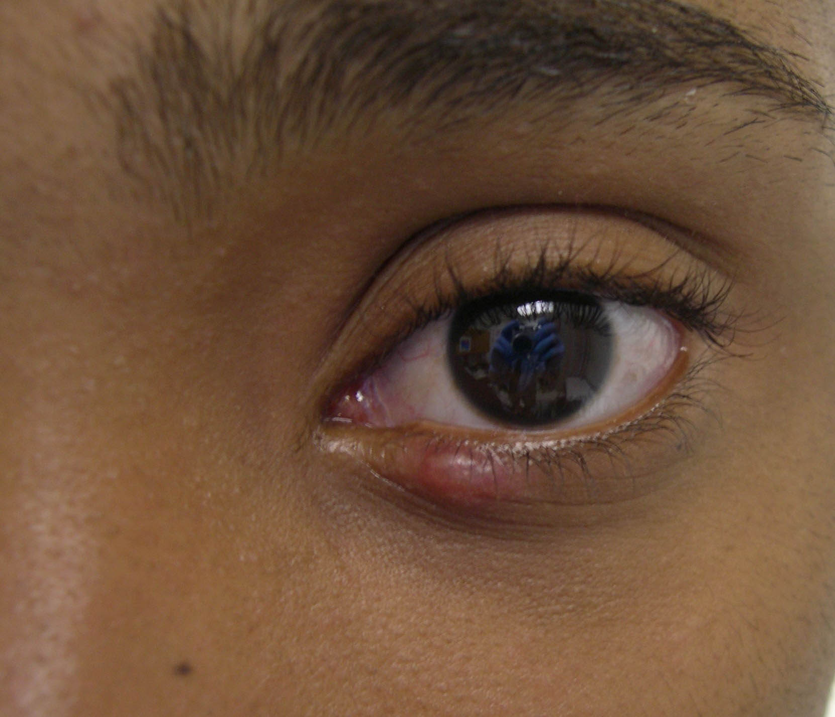 External_Hordeolum Lower eyelid stye