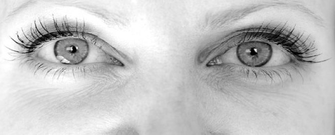 Wrinkles under eyes