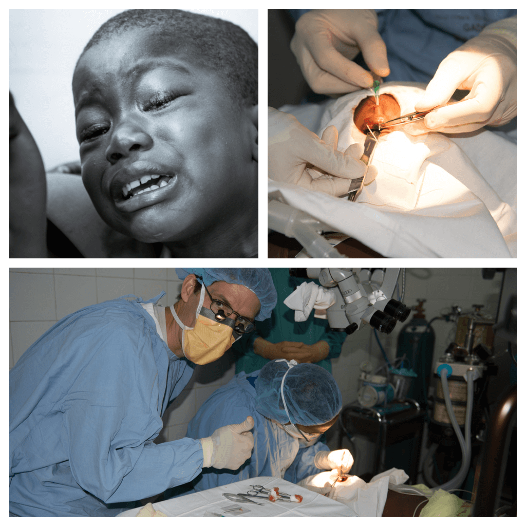 Pediatric ptosis repair in Haiti