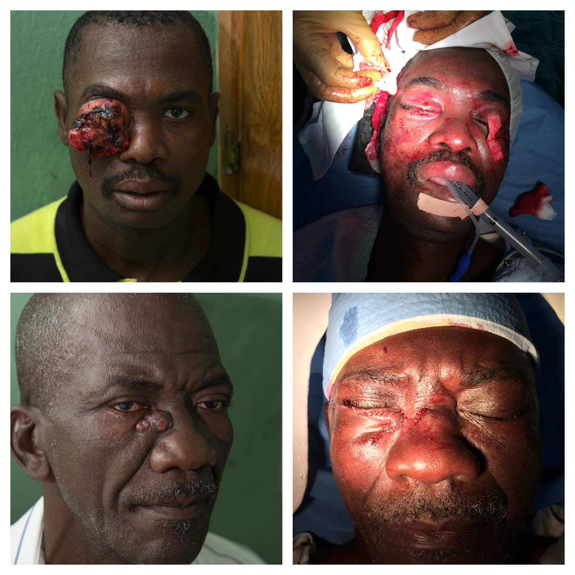 Haiti tumors 2