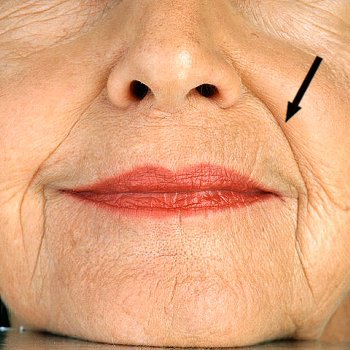 © Copyright 2010 CorbisCorporation nasolabial folds