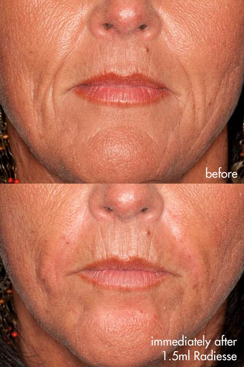 Radiesse Before and After Radiesse to the nasolabial folds