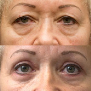 Blepharoplasty before after