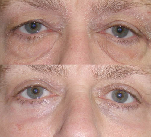 baggy_eyes Blepharoplasty before after