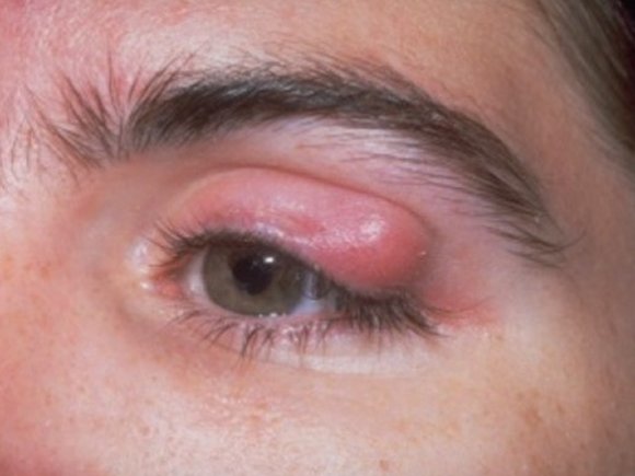 chalazion Upper eyelid infection