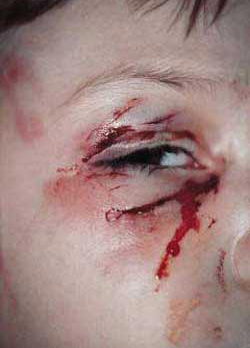 dogbite Trauma to the eye and surrounding periocular region
