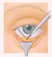 eyebag Laser eyelid surgery