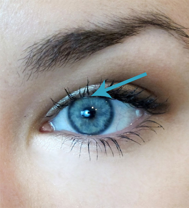 eyelid surgery brow lift