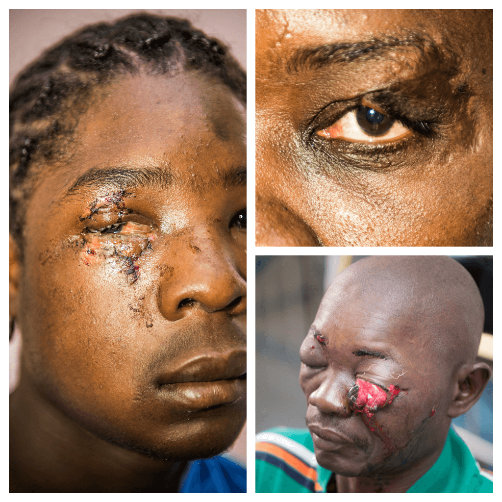 facial trauma