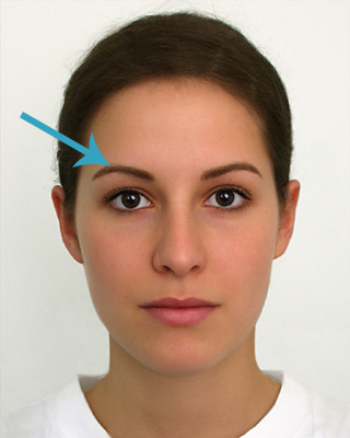 eyelid surgery brow lift