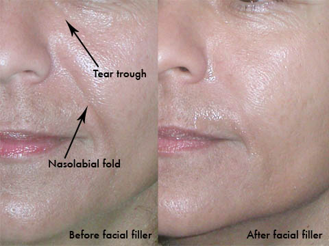 filler Facial filler before and after