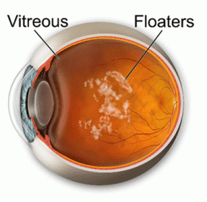 floaters Vitreous floaters