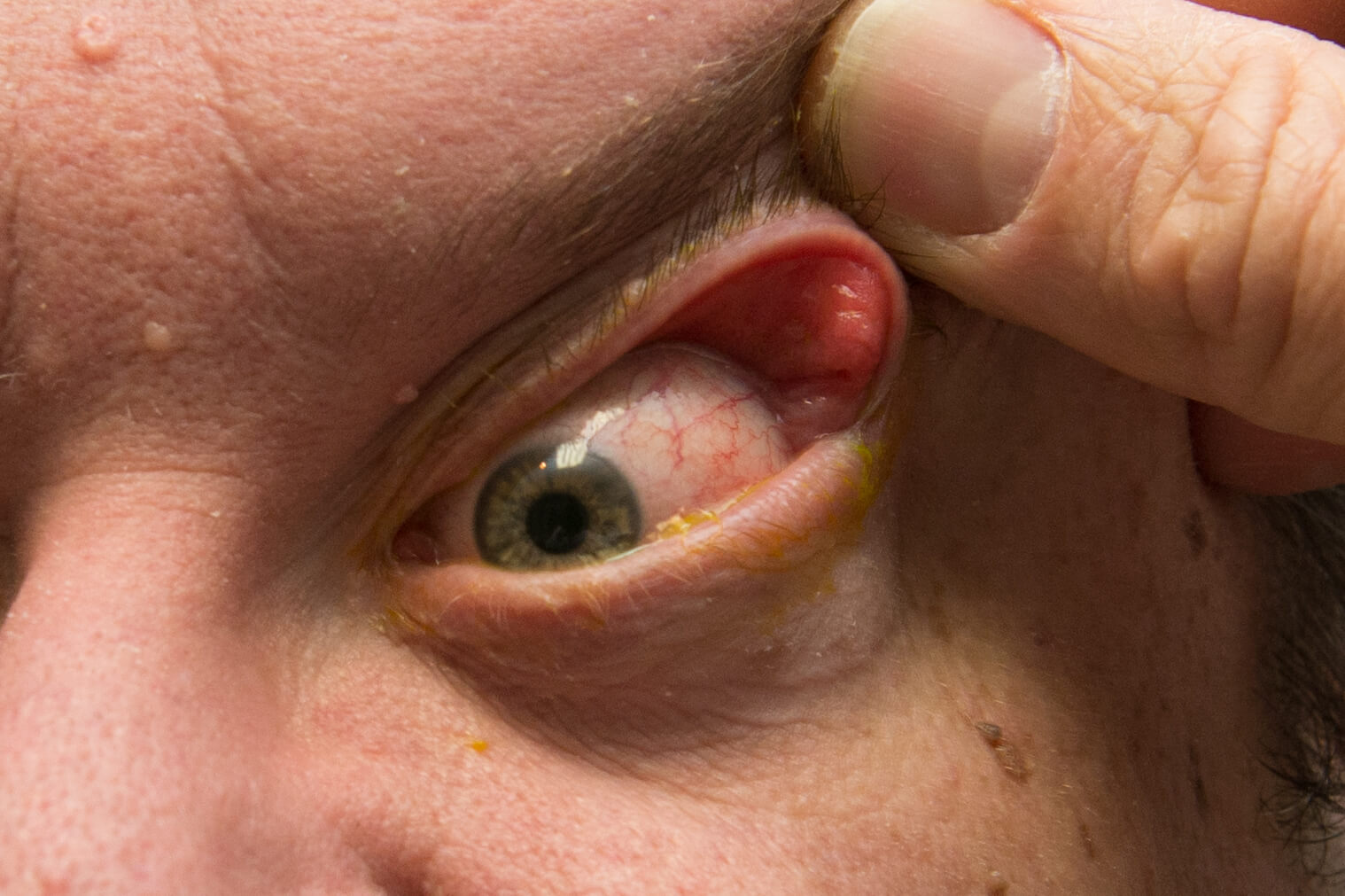 Floppy eyelid syndrome