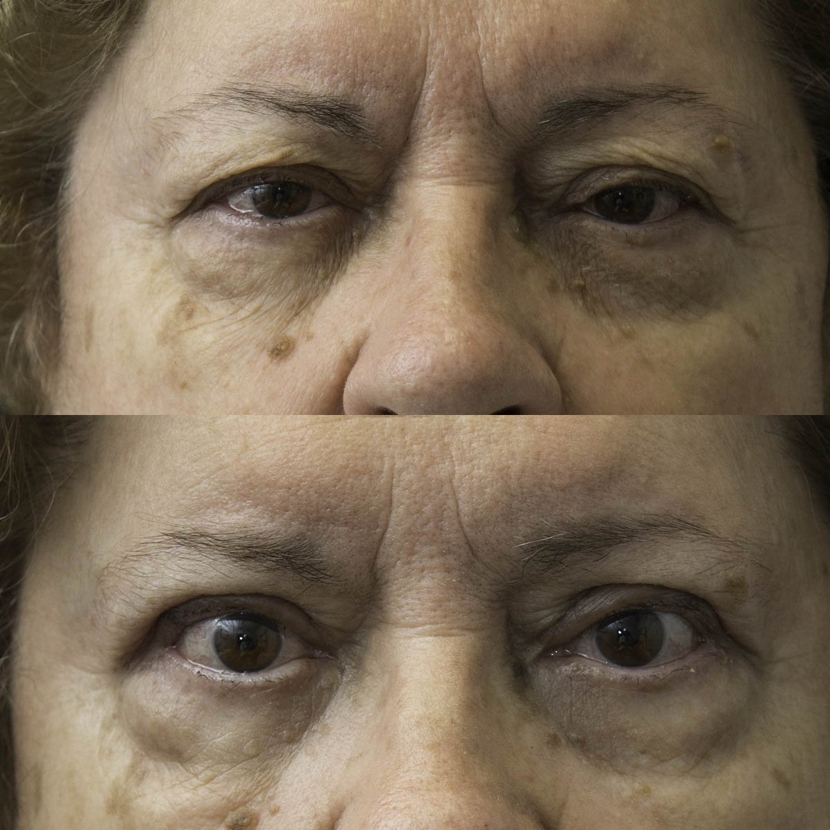 floppy eyelid syndrome surgery