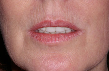 vertical lip line vertical lip lines