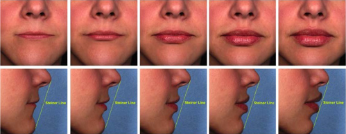 lips Progressive addition of Juvederm to the lips