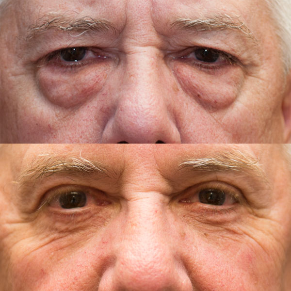 upper and lower blepharoplasty