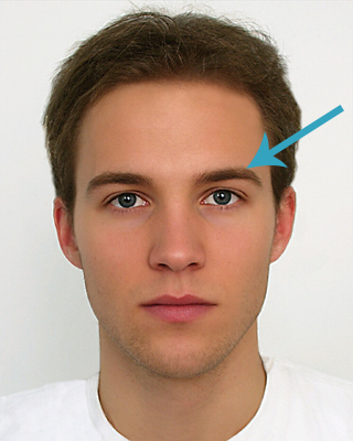 eyelid surgery brow lift