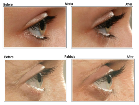Latisse competitor neulash