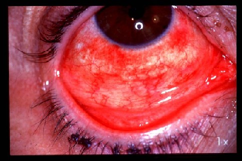 pink-eye-viral Severe conjunctivitis