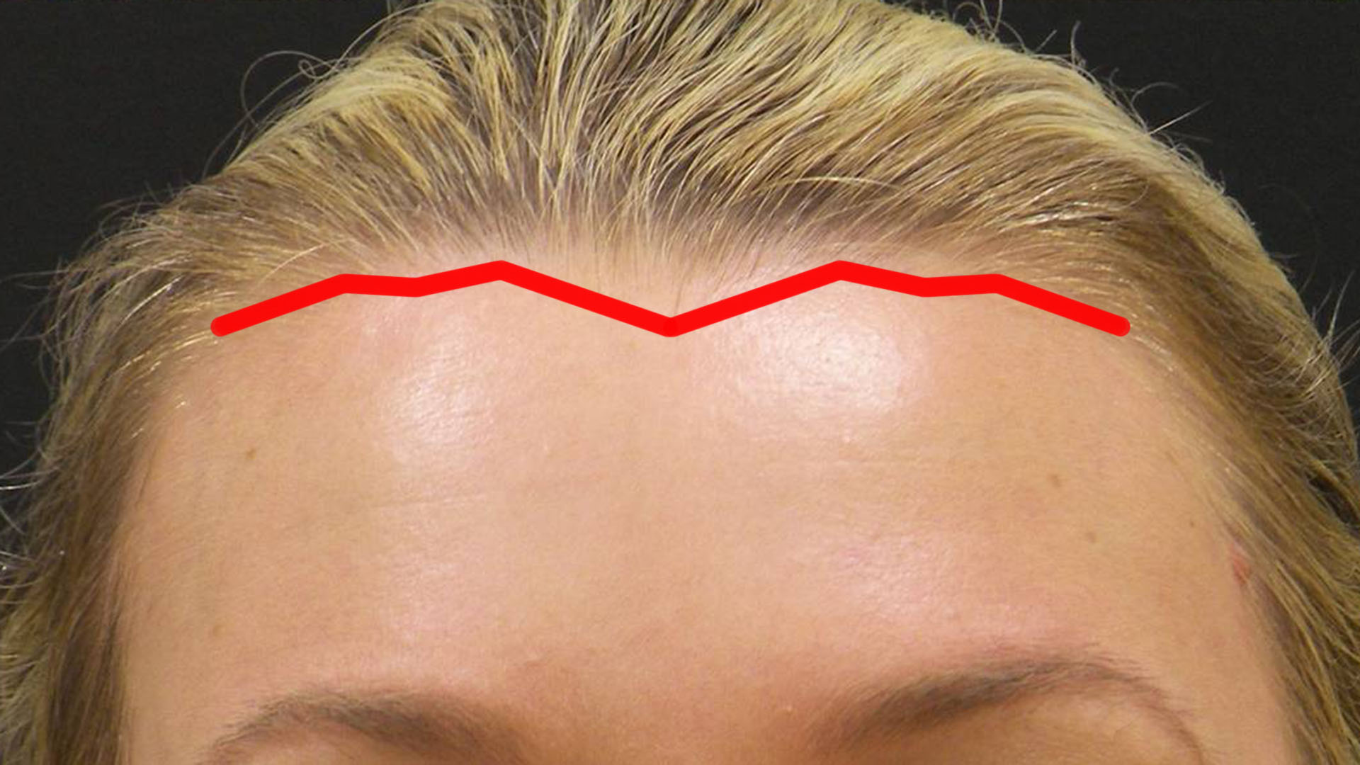 Pretrichial brow lift incision