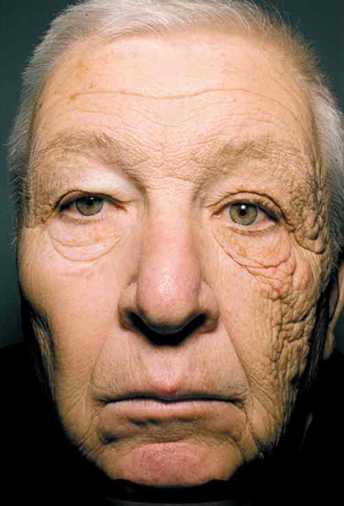 sun_damaged_face Facial aging from sun exposure