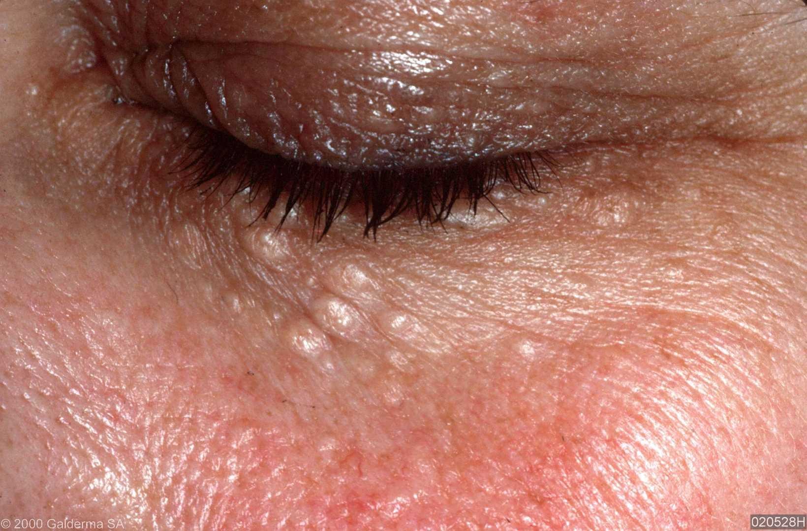 eyelid bumps called syringomas