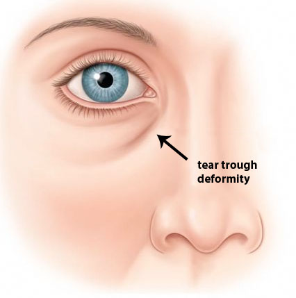 tear_trough tear trough deformity