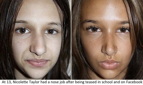 Image from RealSelf.com, article by Melissa Rudy Teen before and after nose job