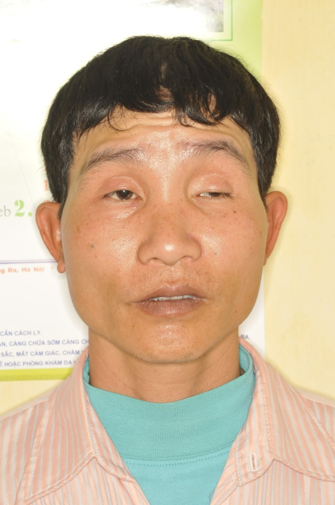 Ptosis (drooping eyelid)