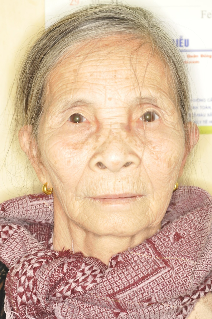 age-related facial wrinkles