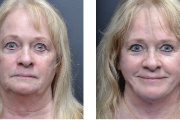 Cosmetic before-and-after photograph 2