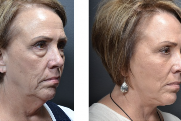 Cosmetic before-and-after photograph 3