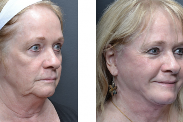 Cosmetic before-and-after photograph 4