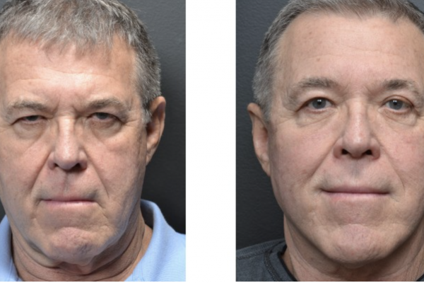 Cosmetic before-and-after photograph 5