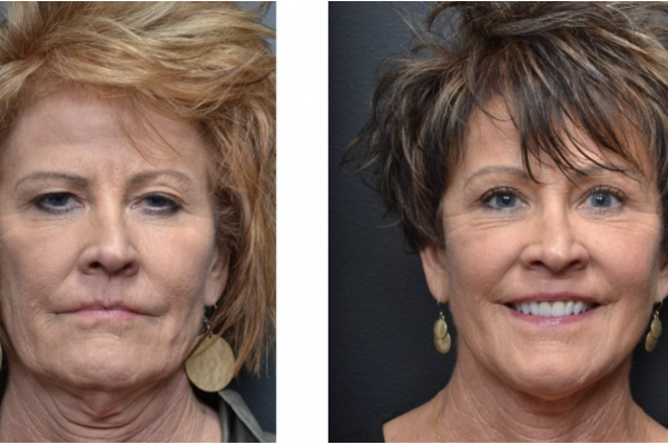Cosmetic before-and-after photograph 6