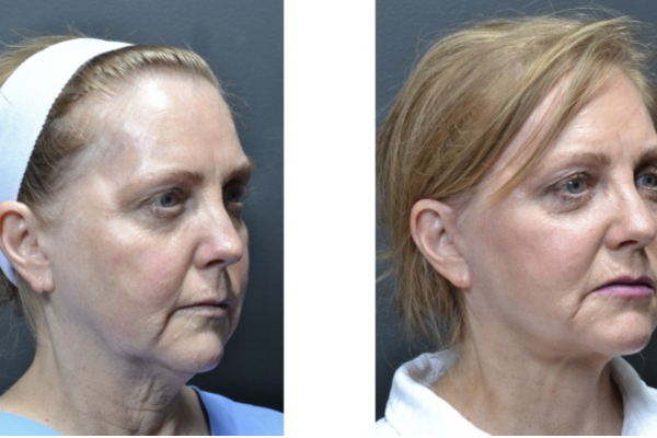 Cosmetic before-and-after photograph 7