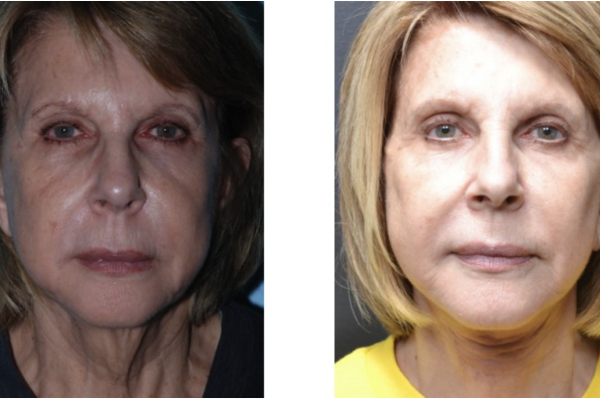 Cosmetic before-and-after photograph 8