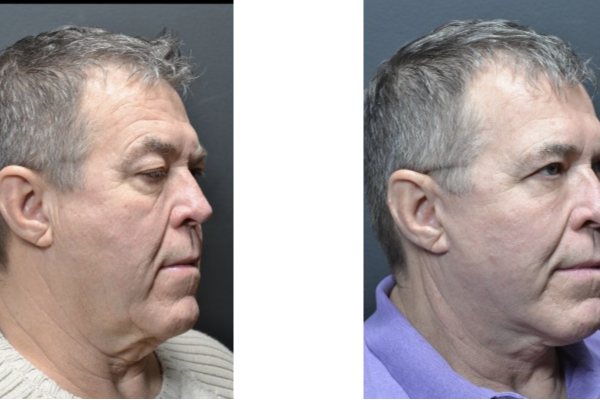Cosmetic before-and-after photograph 9