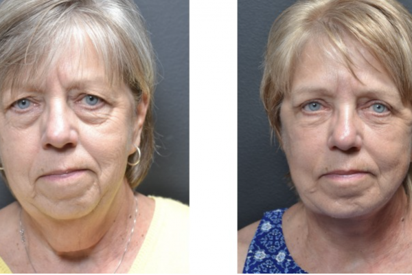 Cosmetic before-and-after photograph 10