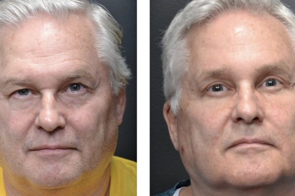 Cosmetic before-and-after photograph 11