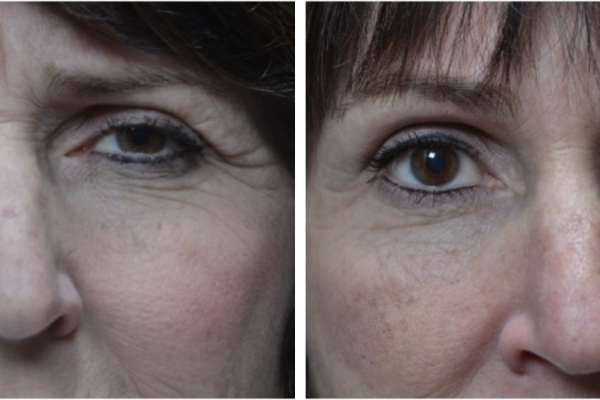Cosmetic before-and-after photograph 12