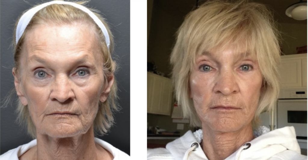 Cosmetic before-and-after photograph 13