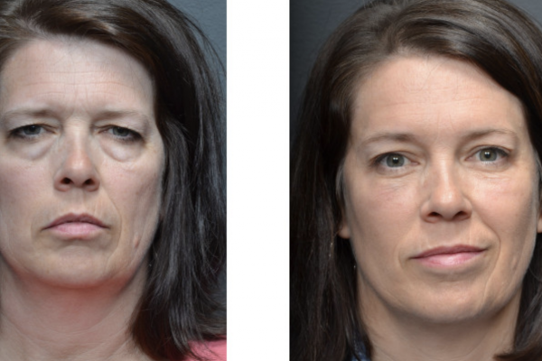 Cosmetic before-and-after photograph 14